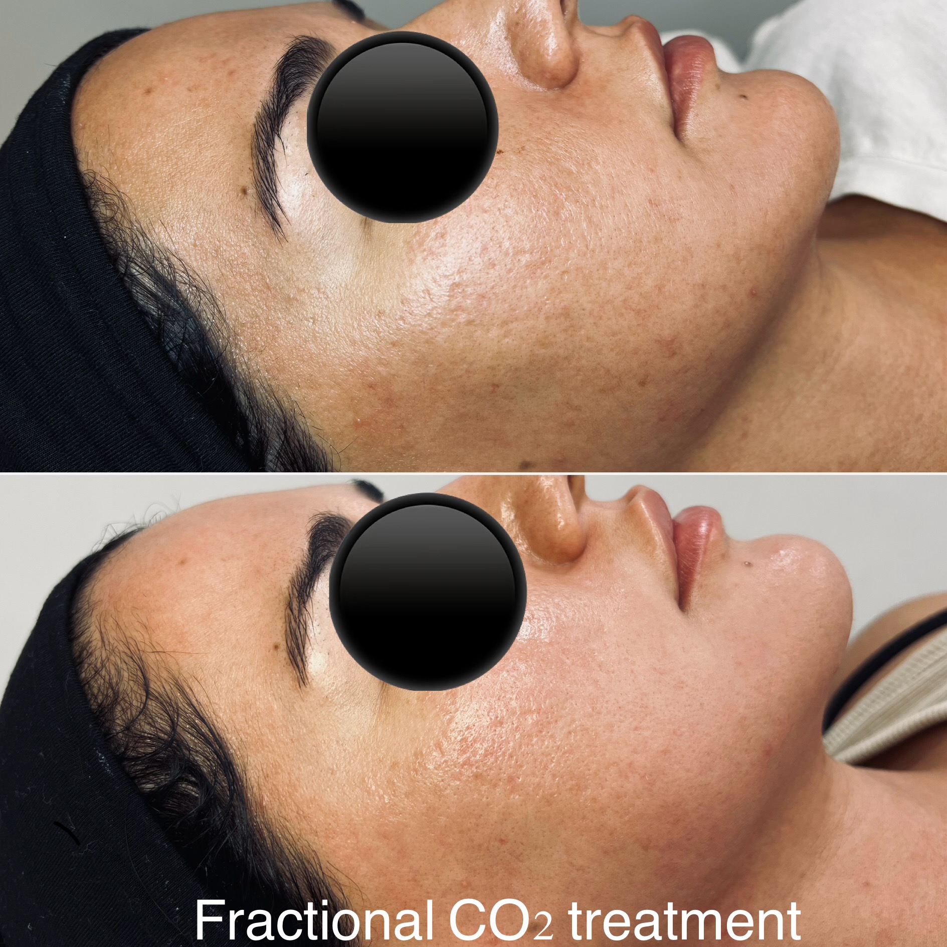 Before and after Fractional CO2 Laser treatment, lower face
