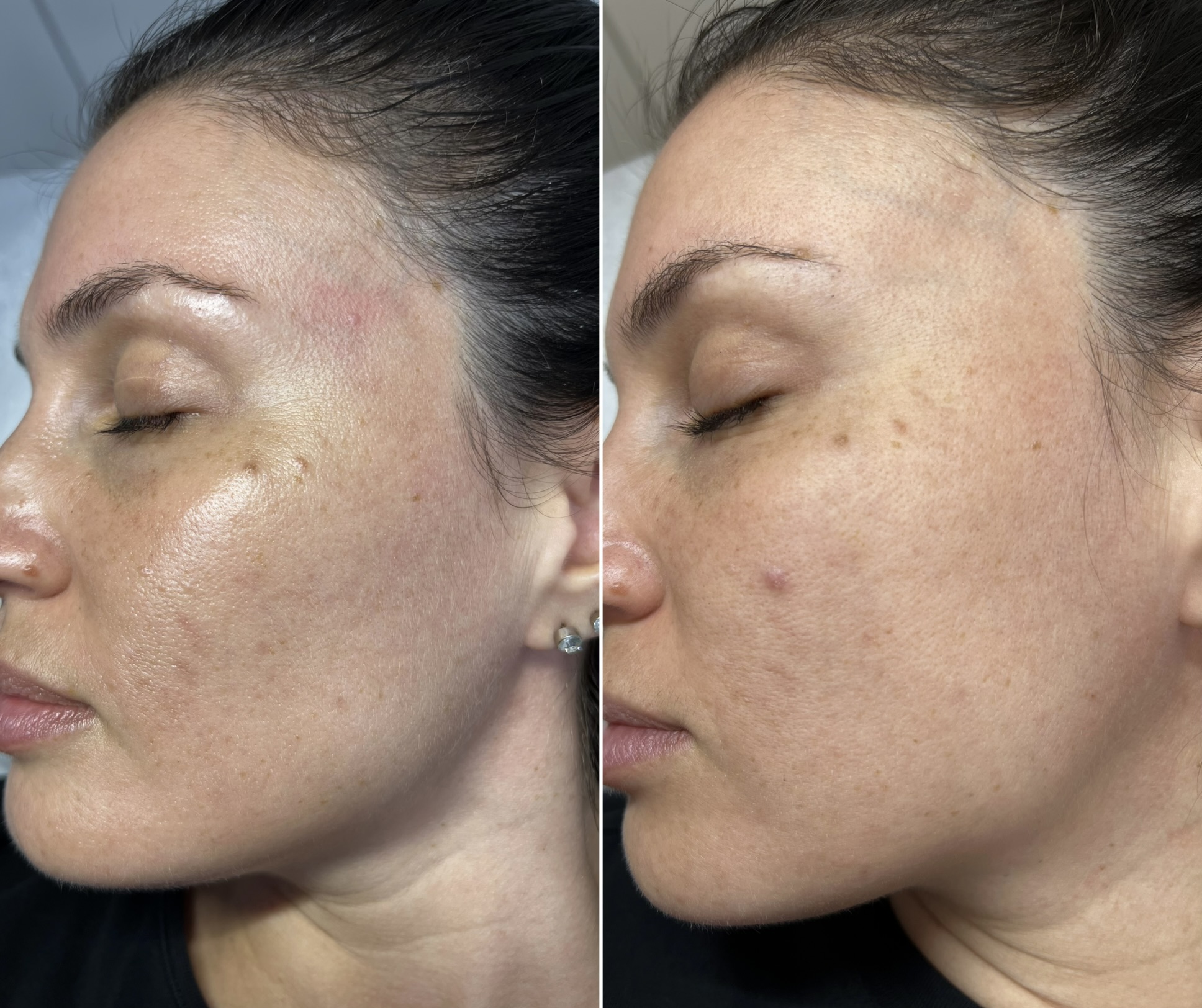 Before and after Fractional CO2 Laser treatment, side profile