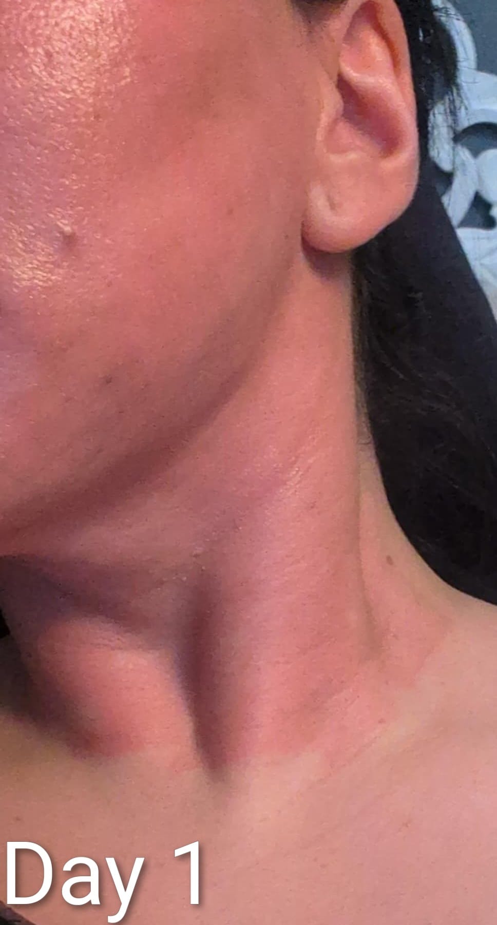 Neck skin one day after Fractional CO2 Laser treatment