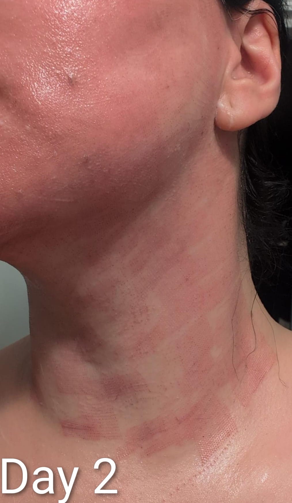 Neck skin two days after Fractional CO2 Laser treatment
