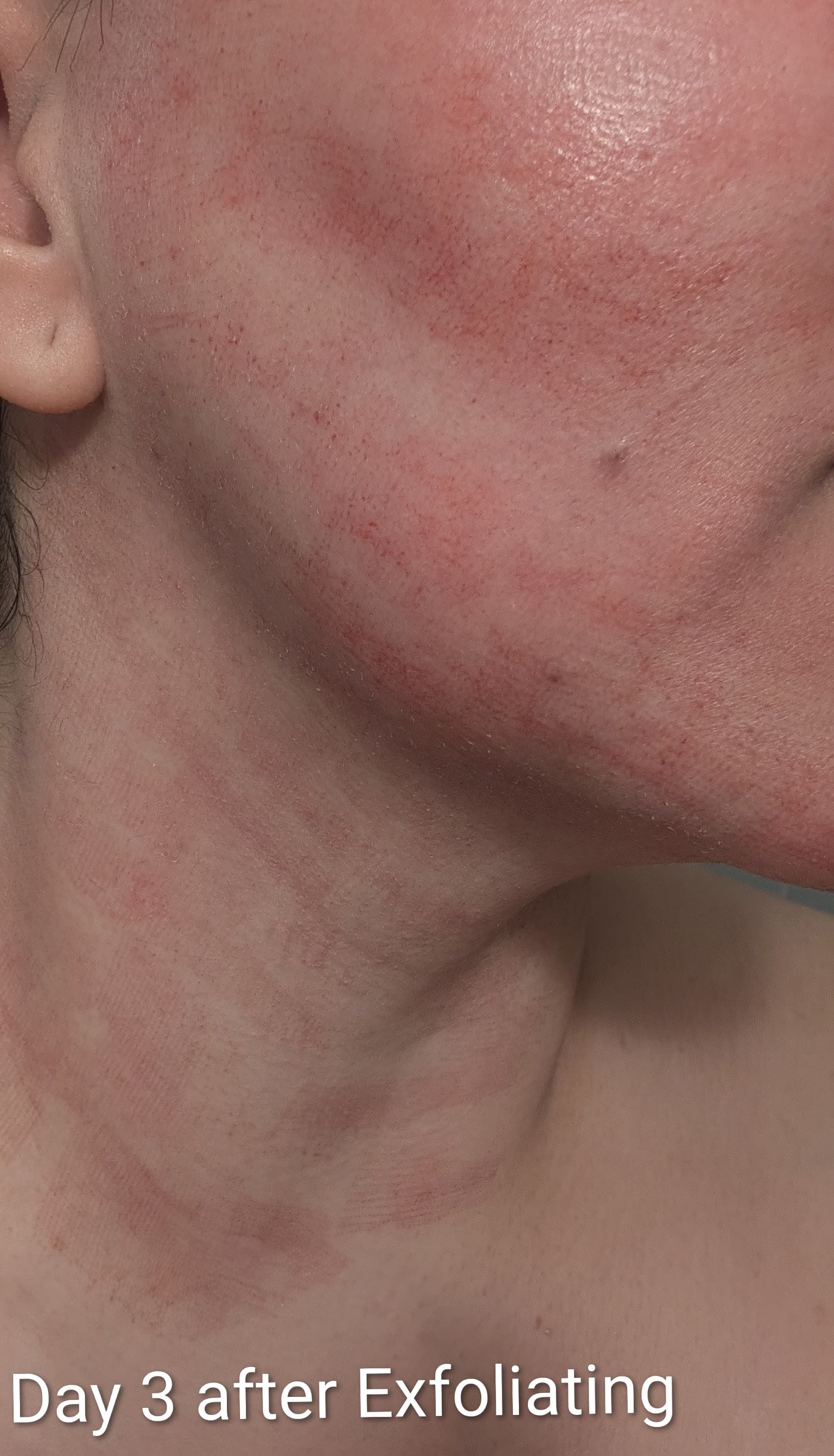 Neck skin three days after Fractional CO2 Laser treatment, after exfoliating